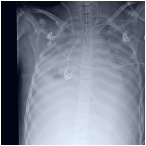 a chest X-ray